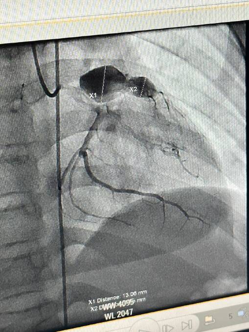 An angiogram picture of the two giant aneurysms on Xavier's left coronary artery. Picture supplied